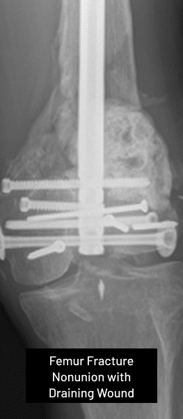 Septic Fractures