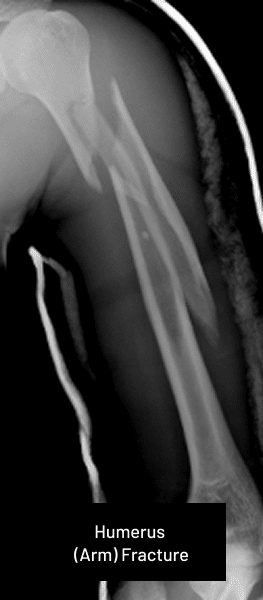 Acute Fractures