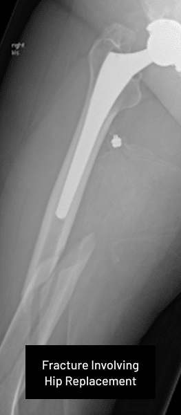 Traumaplasty
