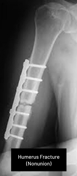 Nonunion Fractures